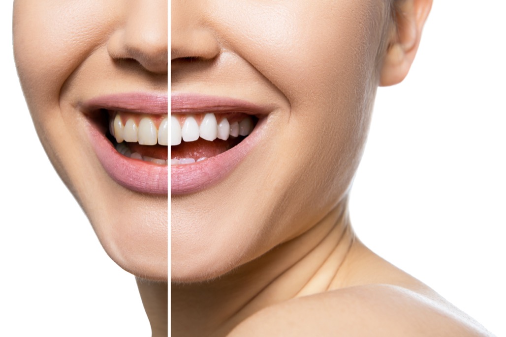 Brighten Your Smile: The Ultimate Guide to Teeth Whitening in Long Beach